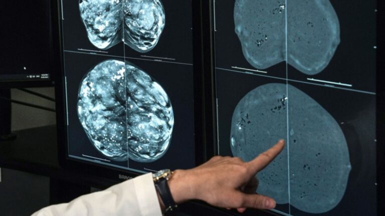 Факт: Нет, Швейцария не запрещала маммографию из-за радиационных рисков, ложных срабатываний