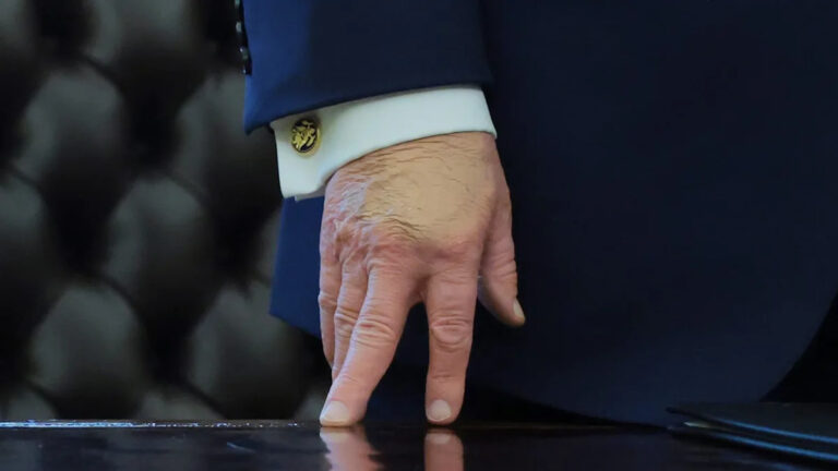 79-летний Трамп торчит руку в макияже, настояв на том, что это измена, чтобы обсудить проблемы со здоровьем