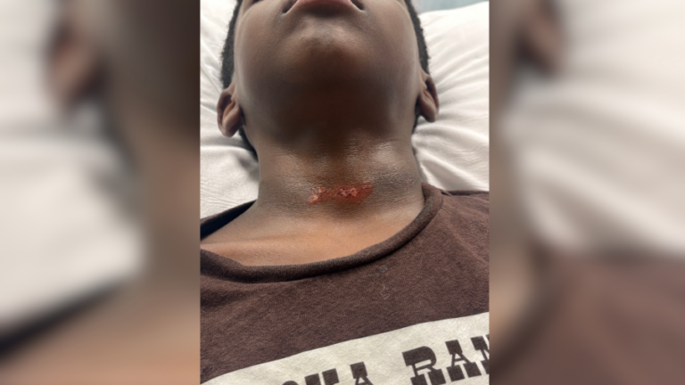 Мать Аполлона Бич ищет ответы после травмы шеи 8-летнего ребенка на школьной площадке